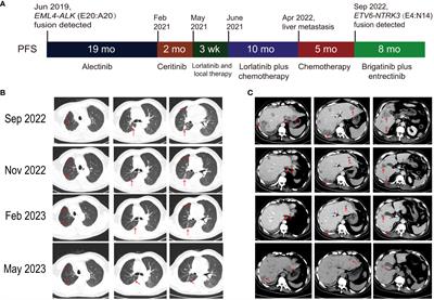 Rapid response to fifth-line brigatinib plus entrectinib in an ALK-rearranged lung adenocarcinoma with an acquired ETV6-NTRK3 fusion: a case report